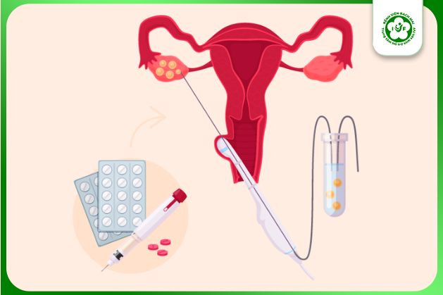 Chọc hút trứng là bước quan trọng trong quá trình thụ tinh ống nghiệm IVF