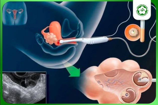 Quy trình chọc hút trứng khi làm IVF