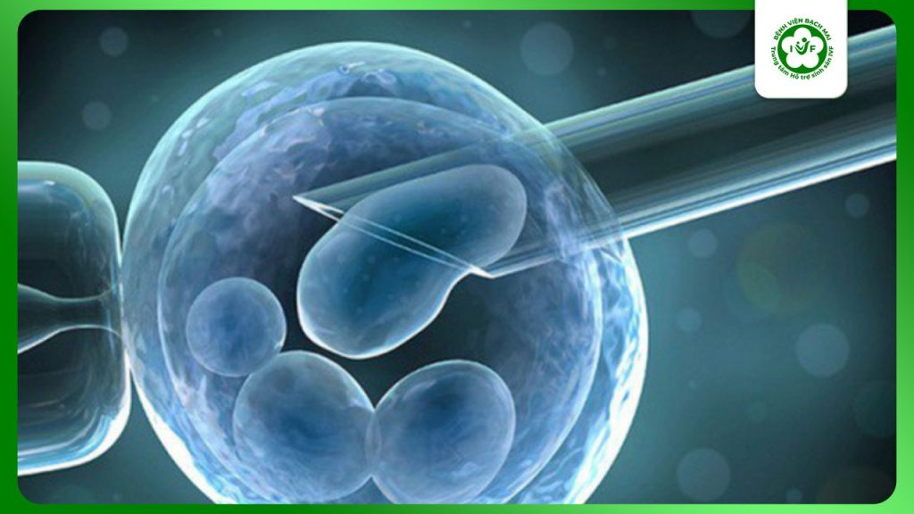 Chọc hút trứng khi thụ tinh ống nghiệm IVF – IVF Bạch Mai