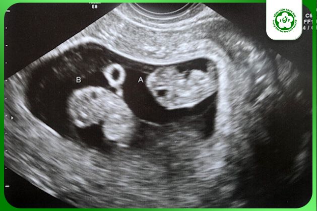 Hình ảnh siêu âm mang song thai